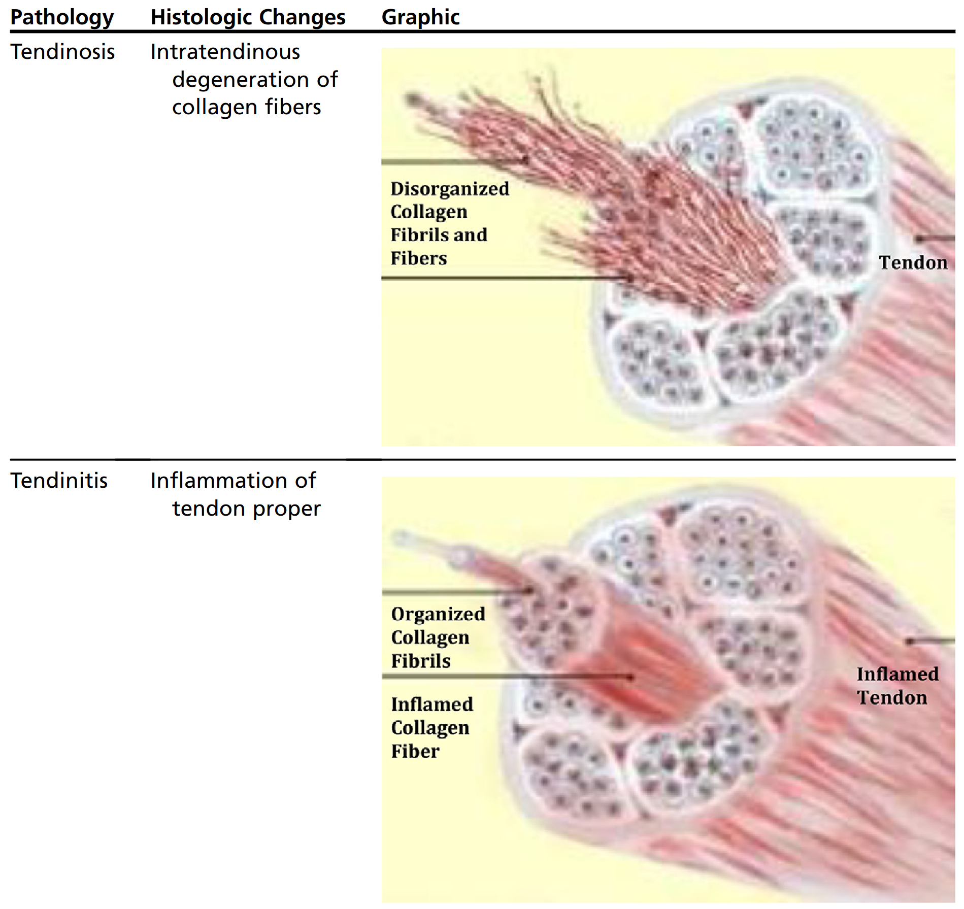 tendon pathology types